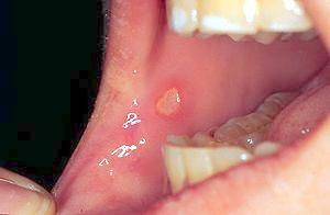 Mouth Lesions Pictures