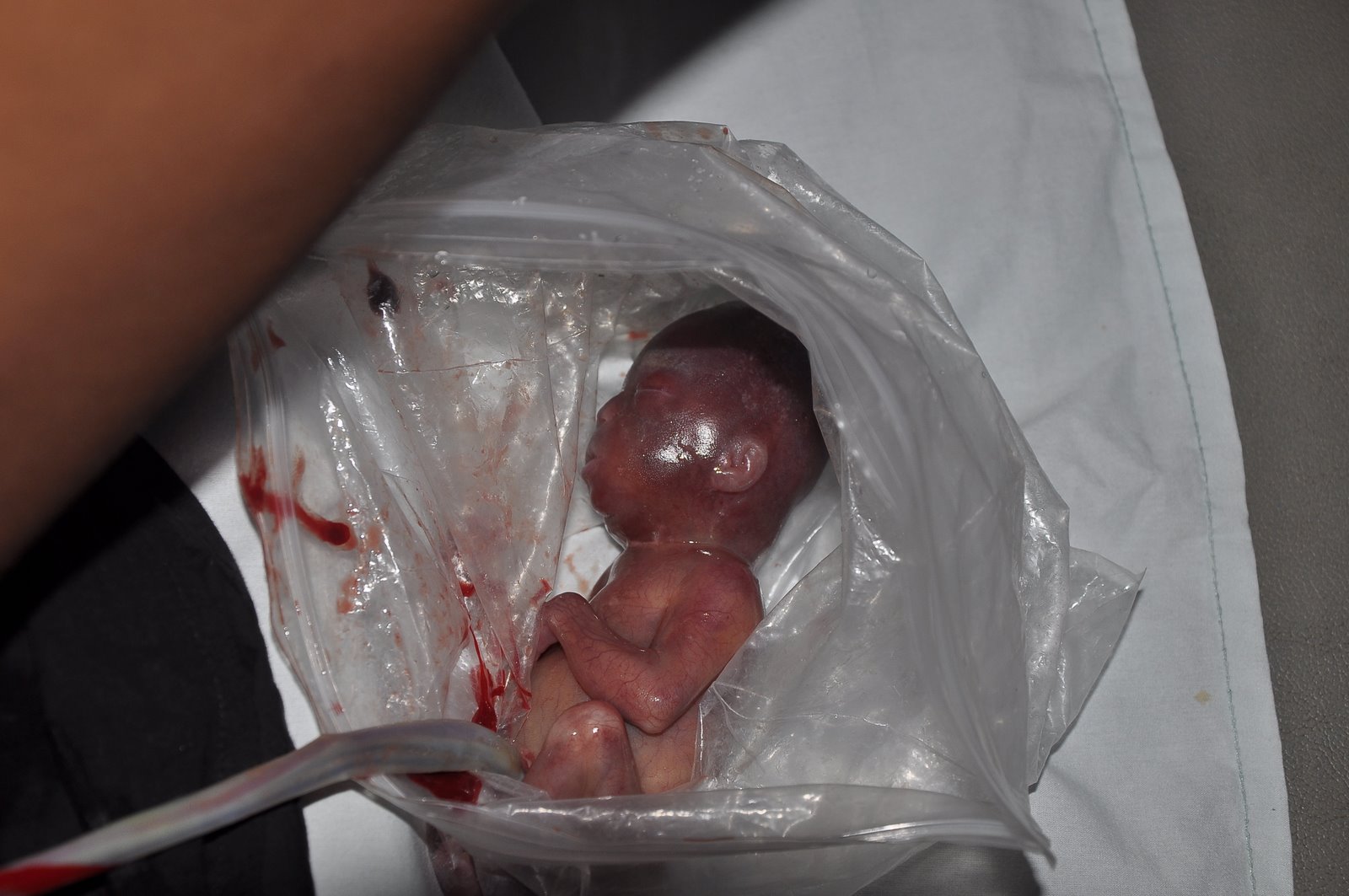 She states that she was three months pregnant and took some pills to ... She states that she was three months pregnant and took some pills to ...