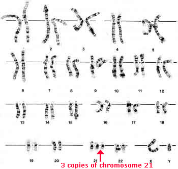 Trisomy 8 Karyotype