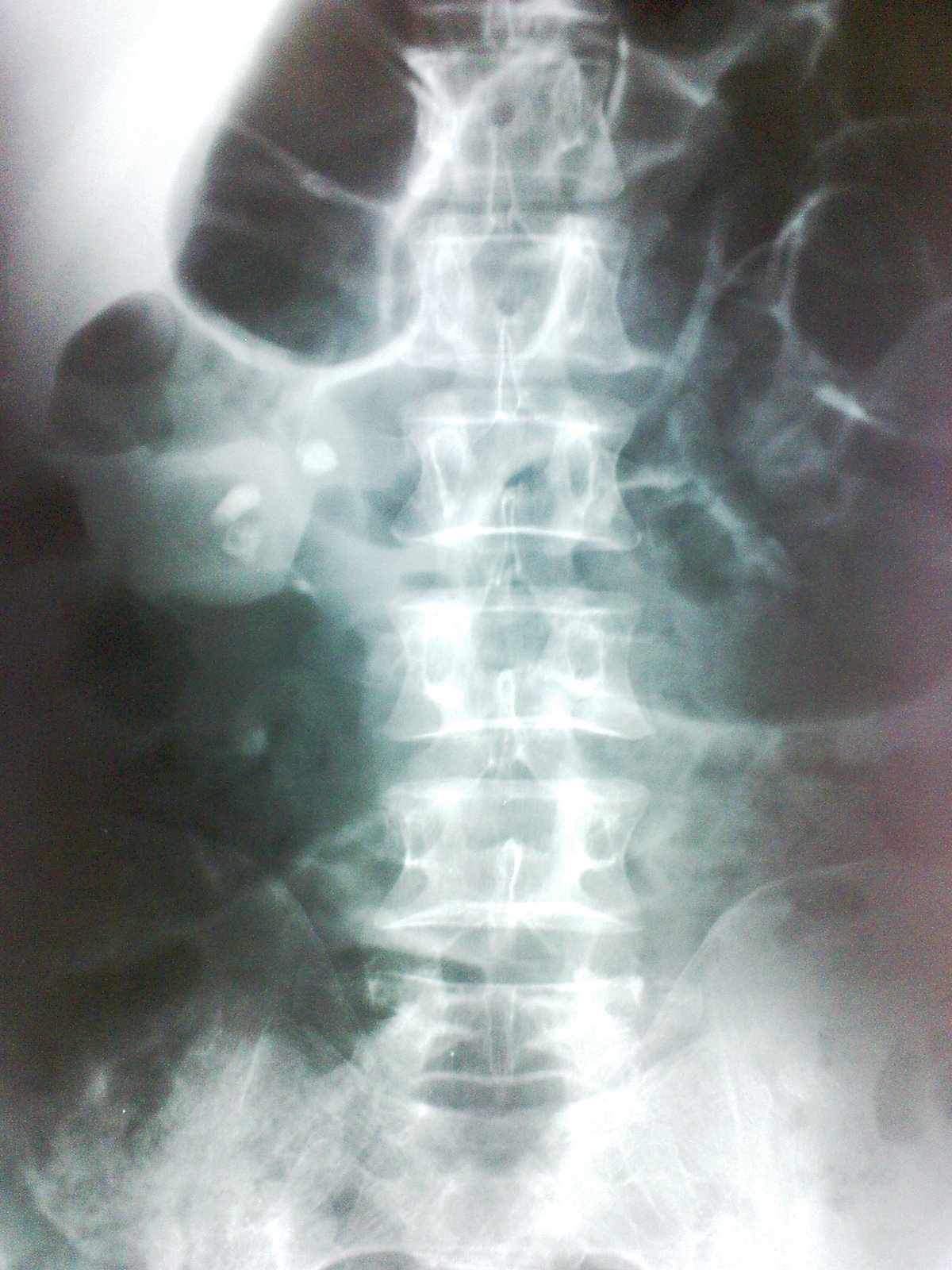 Acute Pancreatitis and CA pancreas