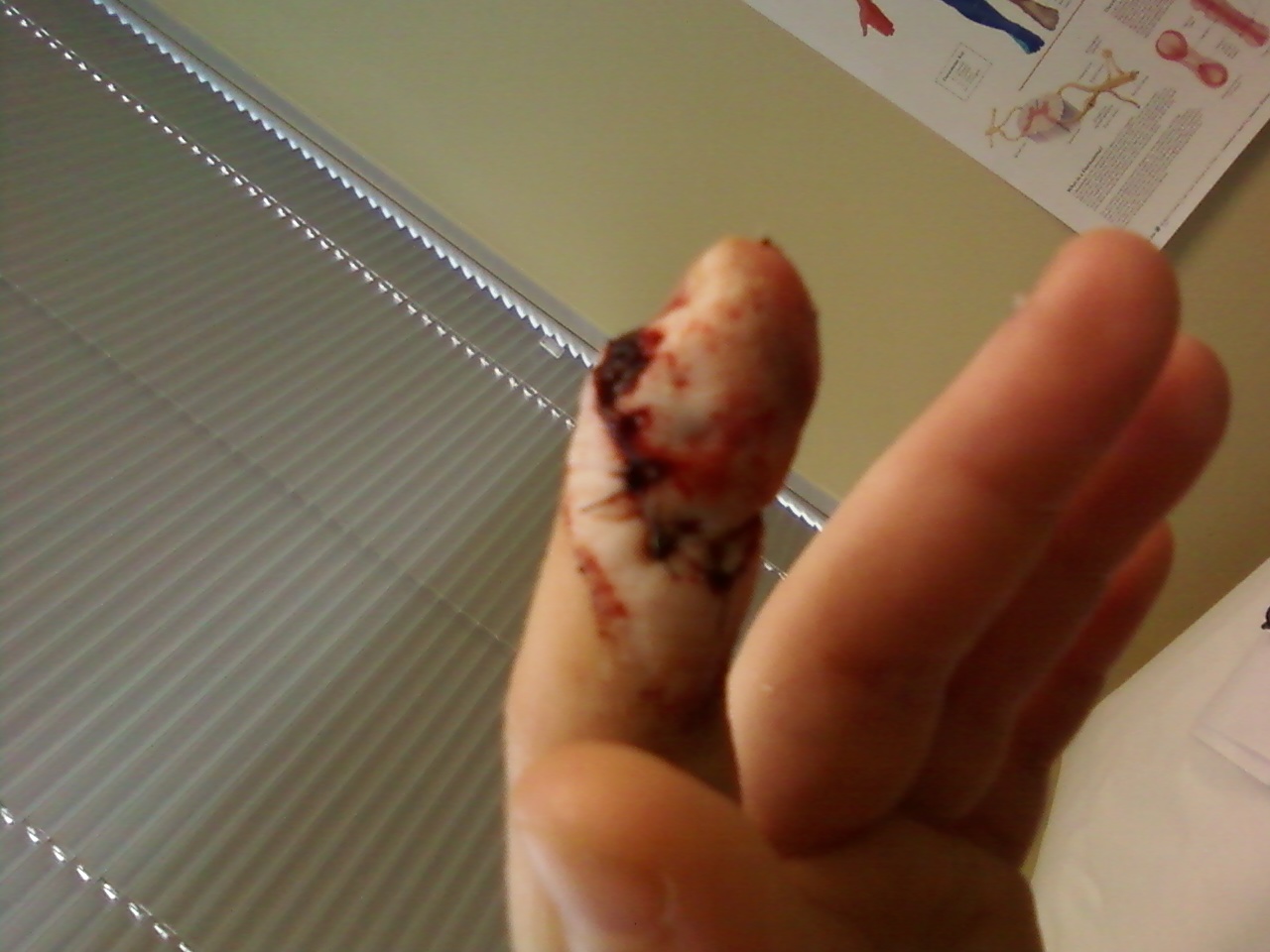 badly cut finger