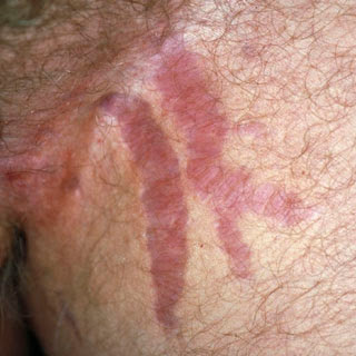 Skin atrophy caused by steroids