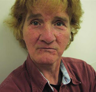 bill clinton rosacea