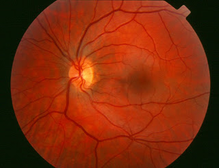 Posterior Pole Retina