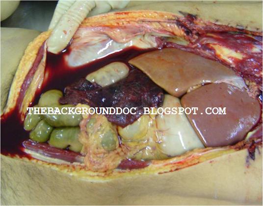 thrombotic thrombocytopenic purpura