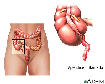 O perigo da apendicite