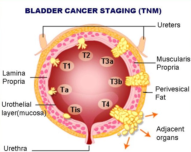 Urothelial+carcinoma