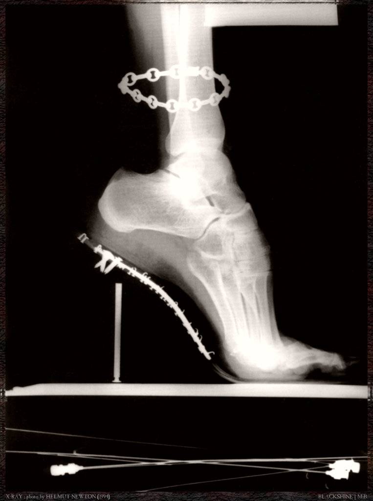 [blk-hnw073-x-ray-foot.jpg]