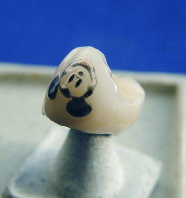 above: Mickey Mouse tattoo on a porcelain molar crown