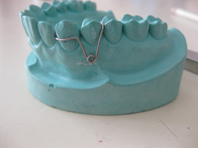 T Spring Orthodontics