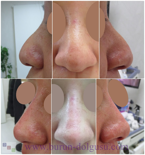 Cost of non-surgical nose job in Istanbul - Cost of non surgical nose job with filler in Istanbul - Cost of non-surgical rhinoplasty in Istanbul - Cost of nose tip filler augmentation in Istanbul - Nose filler injection cost in Turkey - Non-surgical nose job cost in Istanbul - Non-surgical nose job istanbul - Cost of nose filler injection Turkey - Cost of injectable nose job - Cost of liquid rhinoplasty in Istanbul