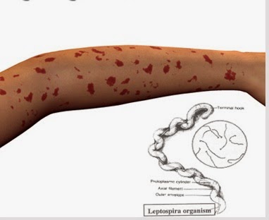 Terapi Non Farmakologi Penyakit Leptospirosis Terapi Non Farmakologi Penyakit Leptospirosis