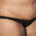 Homeopathic way to Get Rid of Stretch Marks in a Week