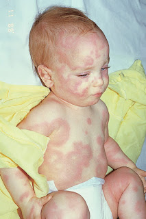 Pediatrics Notes: Introduction To Different Skin Erythemas In Children