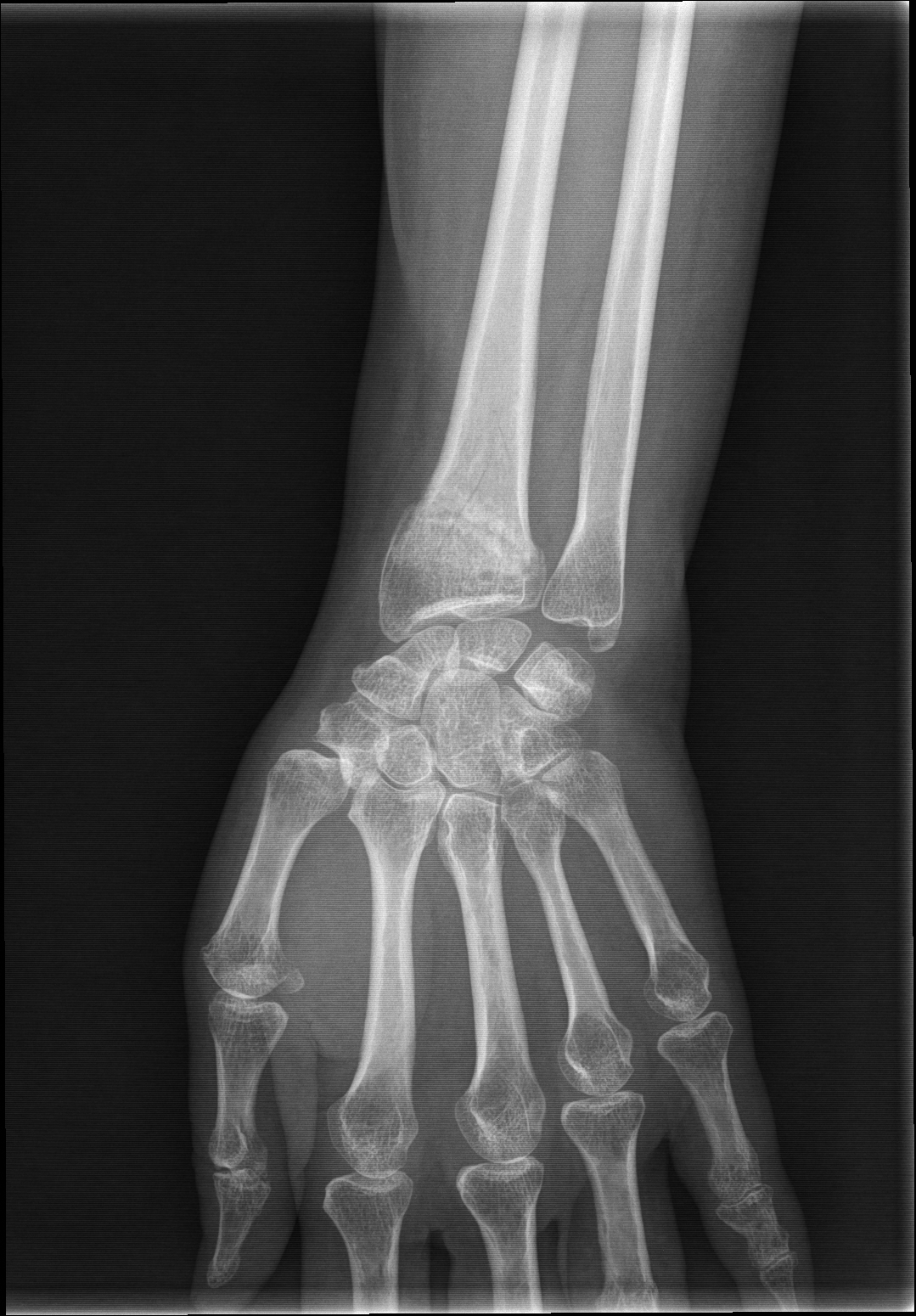 X Ray Wrist Joint Post Trauma Radiology Imaging