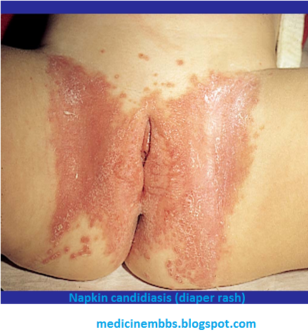 Rash in vaginal area - Dermatology - MedHelp