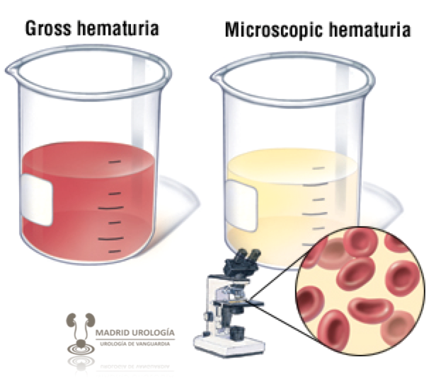 Madrid Urología Cáncer de Vejiga. Diagnóstico Presentación clínica. MU. Capítulo 3. Sección 1. Madrid Urología Cáncer de Vejiga. Diagnóstico Presentación clínica. MU. Capítulo 3. Sección 1.
