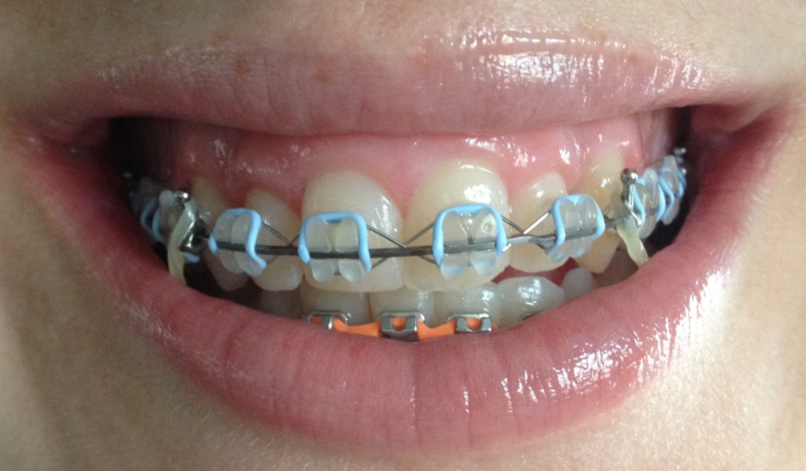 Braces Chick Elastics and Polishing.