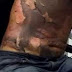 Mulher coloca fogo no marido dormindo por ciúmes de outro homem