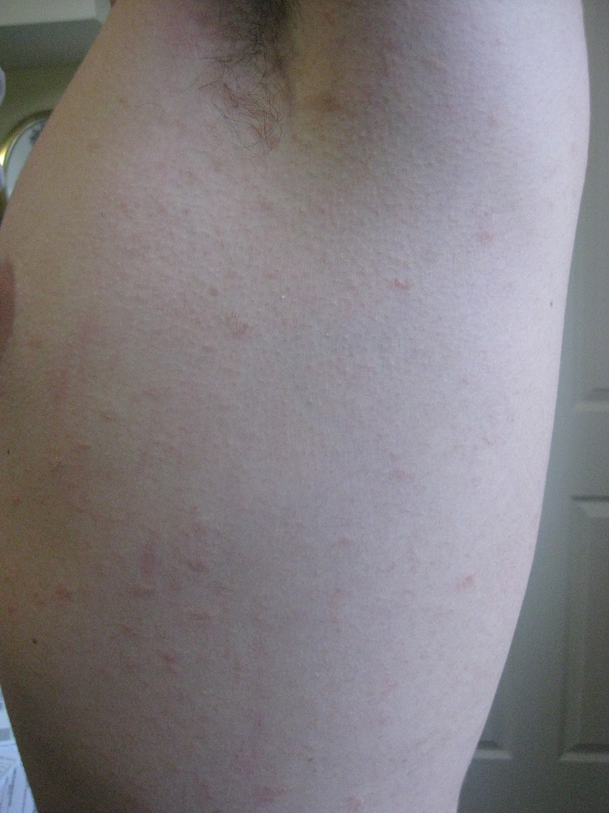 pityriasis rashes #11