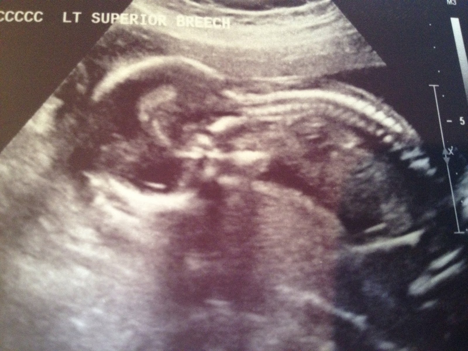 Bring It on The awesome Level II ultrasound