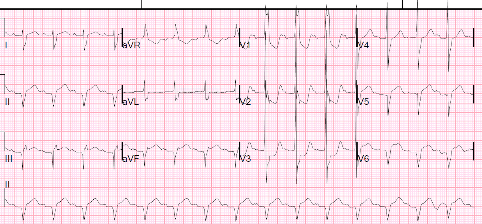 Dr. Smith's ECG Blog Nausea and Vomiting. This ECG is loaded with