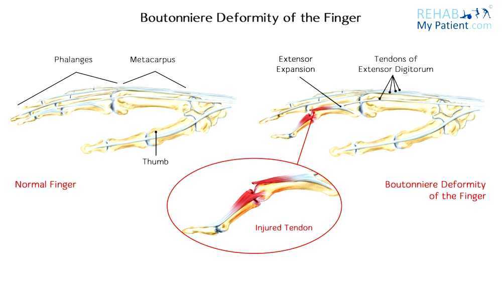 Boutonniere deformity