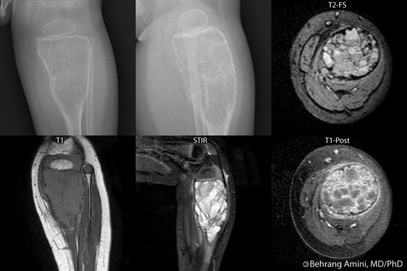 Roentgen Ray Reader: Aneurysmal Bone Cyst