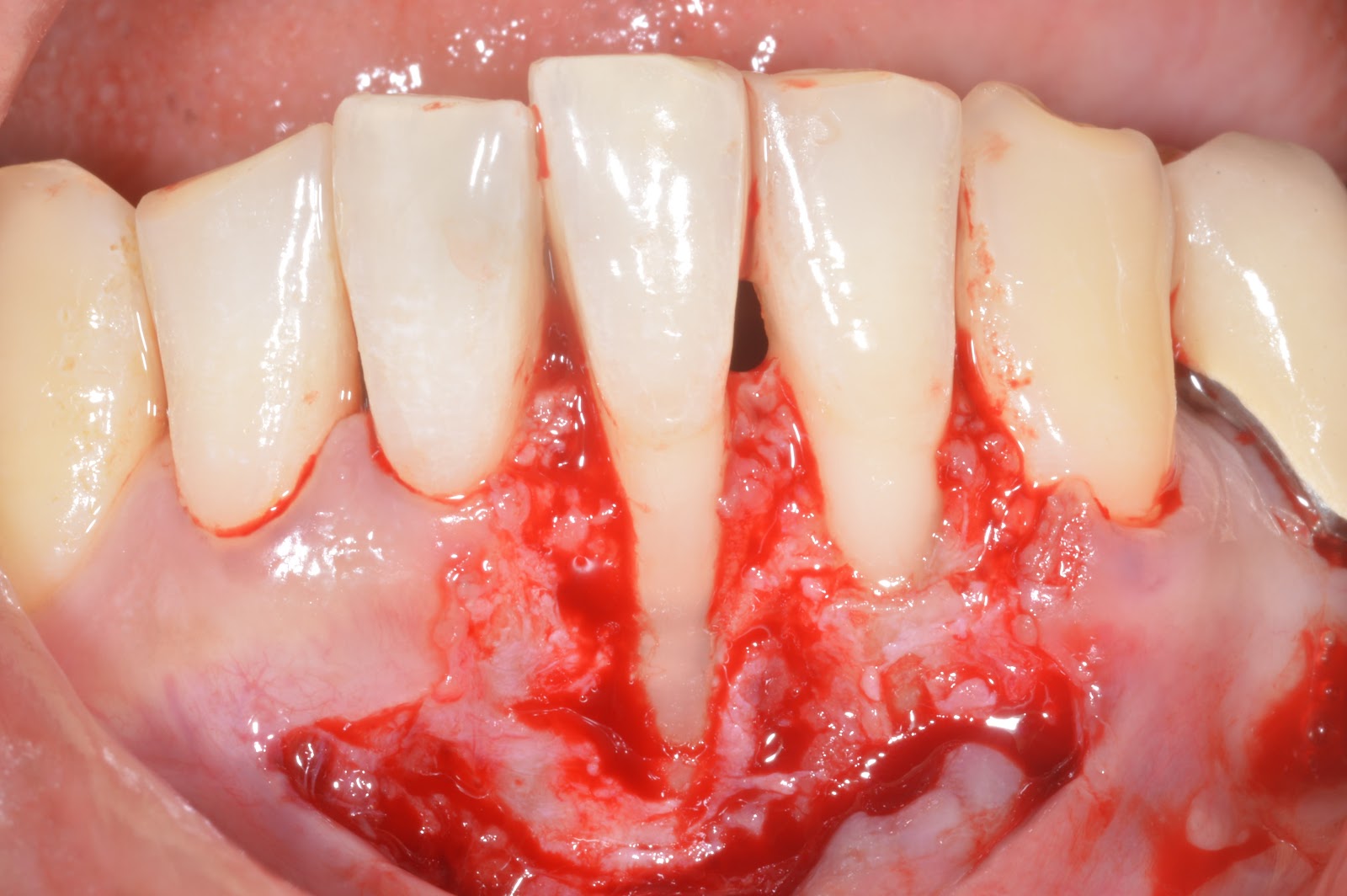 gingival recession