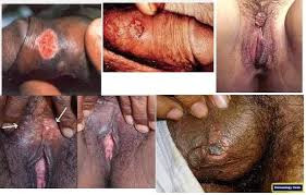 Obat Sipilis Aman Dan Efektif Obat Sipilis Aman Dan Efektif