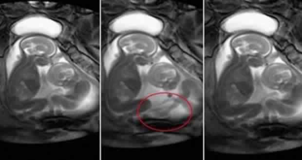 Une mère enceinte de jumeaux fait une IRM. Elle n’arrive pas à croire ce que ses bébés sont en train de faire !