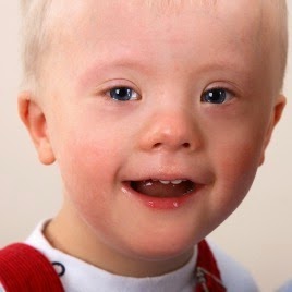 Is Down Syndrome Genetic or Hereditary?
