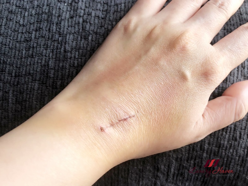 ganglion cyst removal surgery or simply needle aspiration ganglion cyst removal surgery or simply needle aspiration