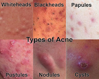 how acne forms