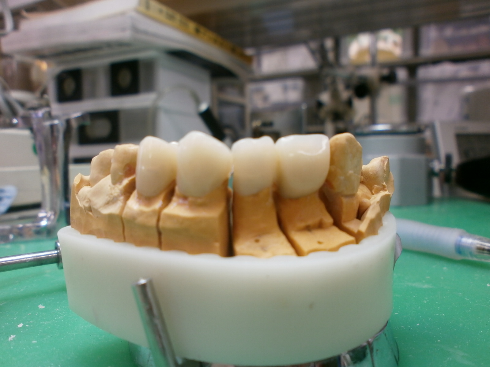 髙田朝（Hajime Takada）のオーダーメイド歯科技工物の紹介 Introduction of custommade dental
