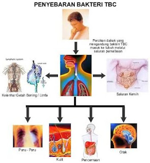 Cara Mengobati TBC Paru pada Anak dan Dewasa Sampai Tuntas