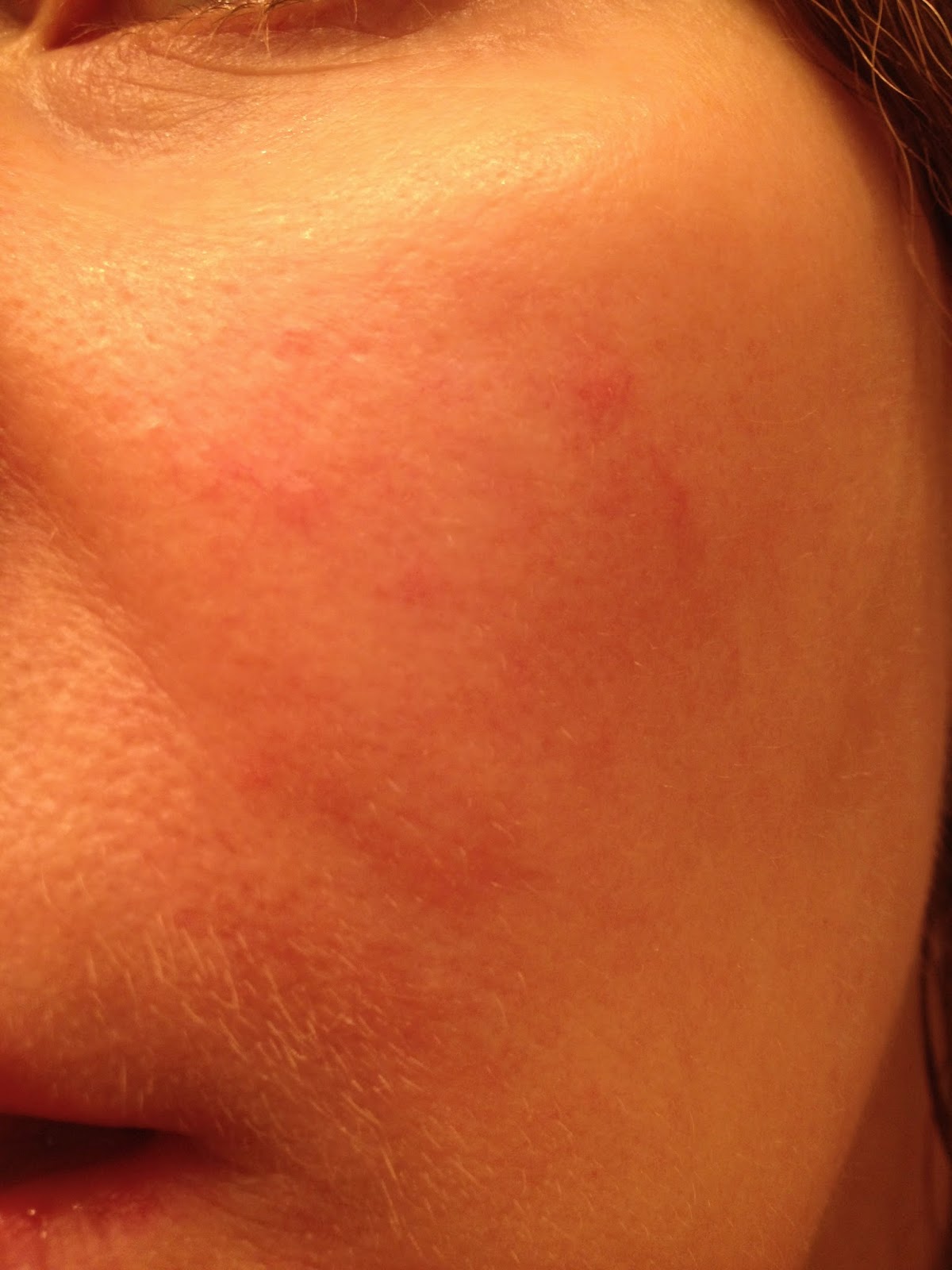Chemical Peels for Acne and Anti Aging: Acne and Rosacea Caused by Mites?