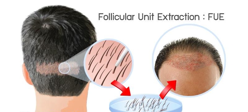 Hair Transplantation Cost Clinic Hair Transplant In Delhi
