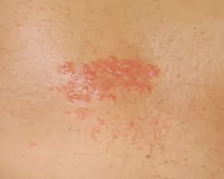 Look for Your Rash in These Rash Pictures - Verywell