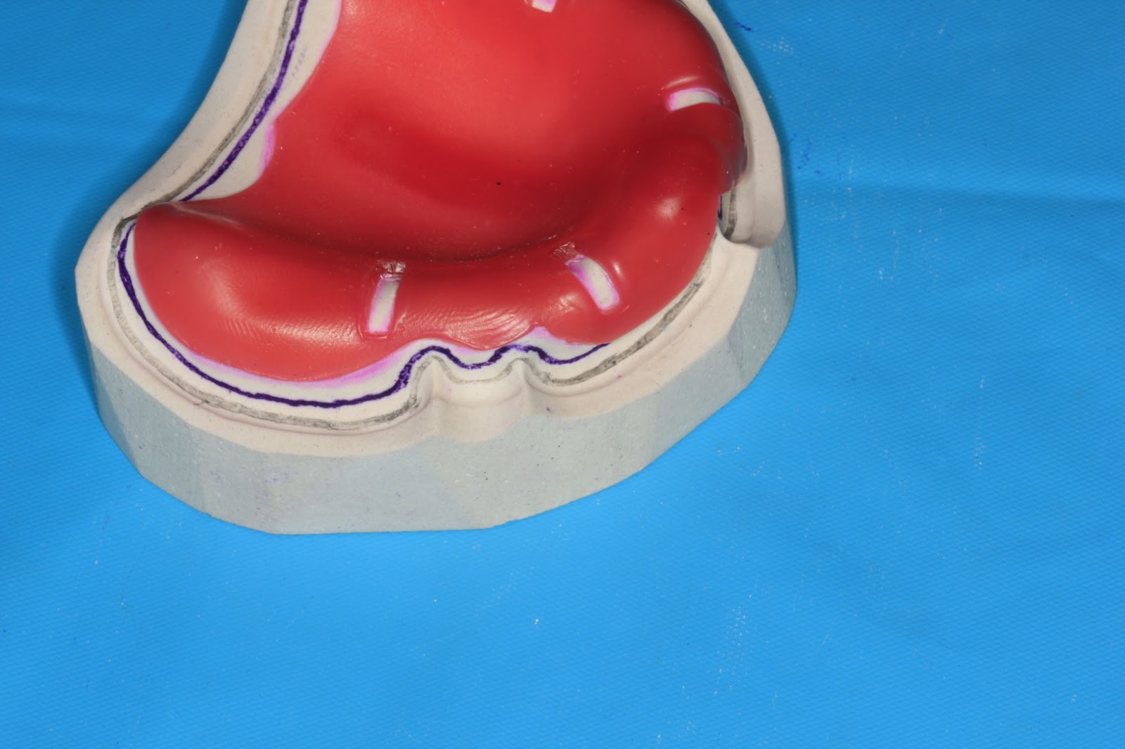 Understanding Prosthodontics Tagore Dental College & HospitalBy