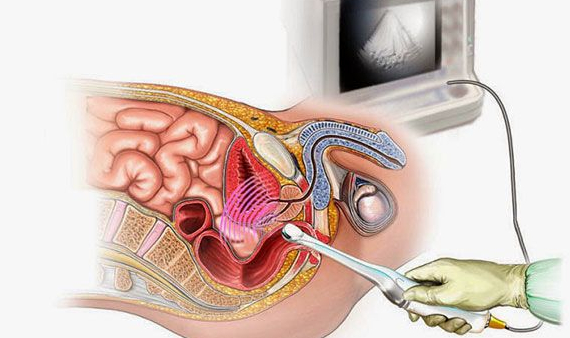 symptoms of intestinal cancer and Survival Rate symptoms of intestinal cancer and Survival Rate