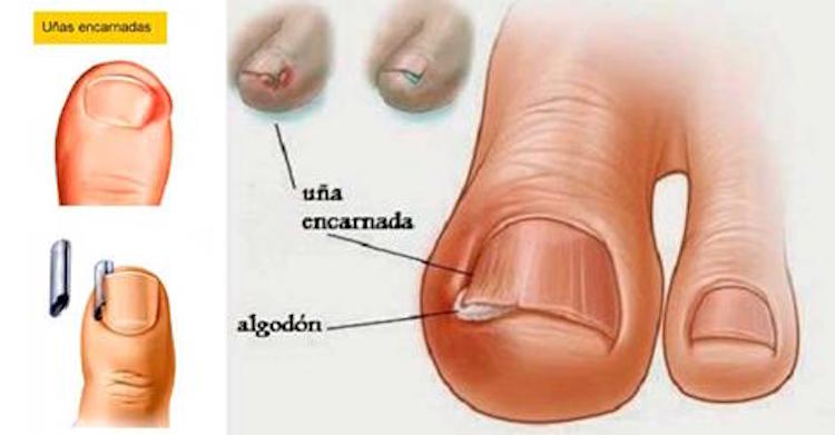 tratamiento para las uñas enterradas