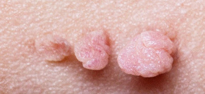 Foto Nama Obat Bintik-Bintik Kecil Kasar Di Kelamin Dan Terasa Gatal