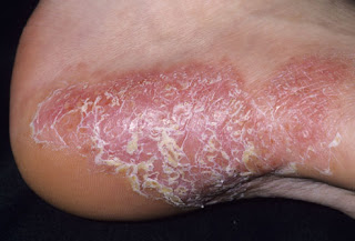 penyakit kulit psoriasis