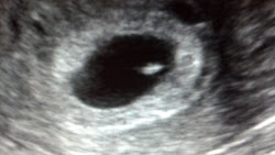 6w2d ultrasound