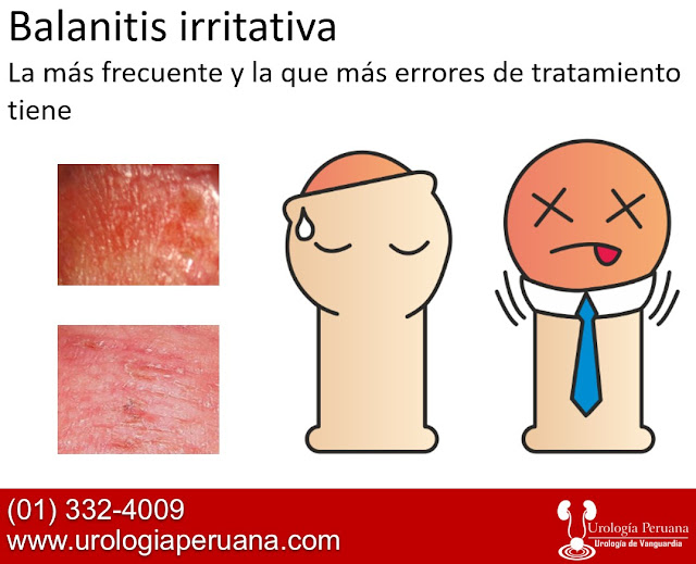 BALANOPOSTITIS TRATAMIENTO PDF BALANOPOSTITIS TRATAMIENTO PDF
