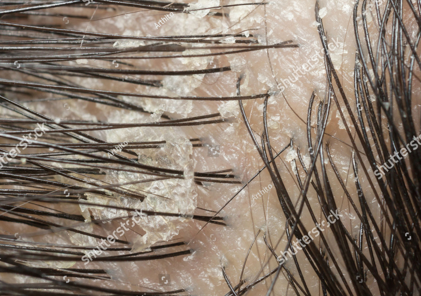 Do Not Take Dandruff Lightly