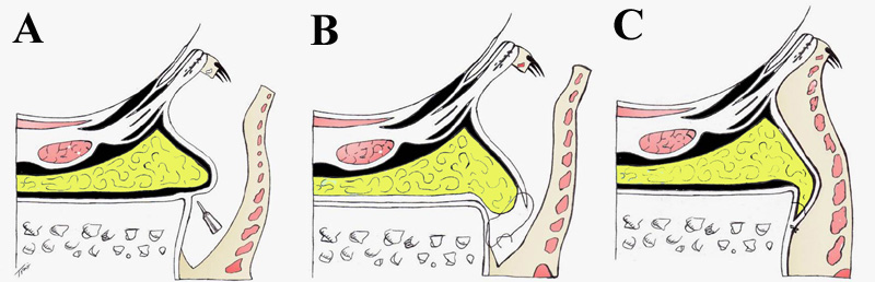 Eyelid Surgery by Prof Dr CN CHUA 蔡鐘能: Evolution of the Lower Lid ...
