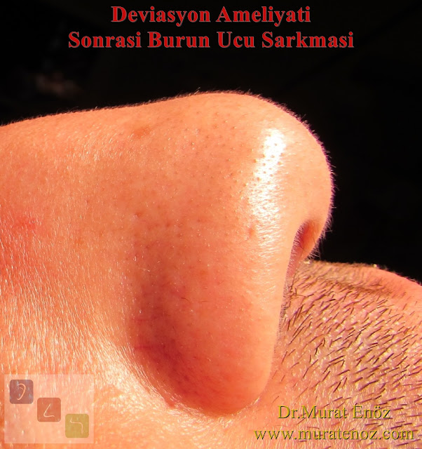burun eti ameliyatında burun şekli değişir mi