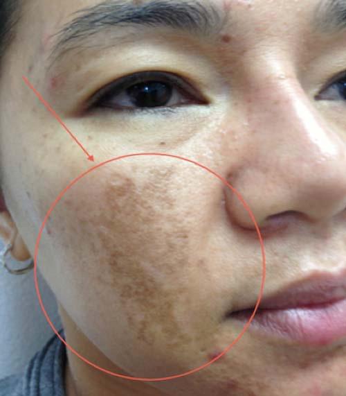 Da đẹp hết nám chỉ với mật ong Da đẹp hết nám chỉ với mật ong